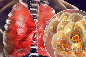 Bệnh viêm phổi: Nguyên nhân, triệu chứng và cách điều trị