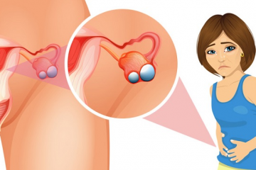 U nang buồng trứng: Nguyên nhân và dấu hiệu nhận biết bệnh