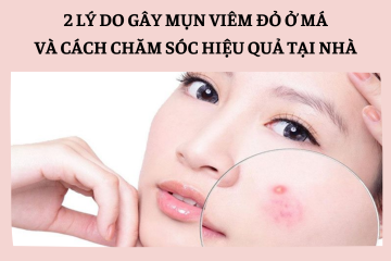 Đâu là nguyên nhân gây nên mụn viêm đỏ ở má khiến bạn đau nhức, khó chịu?